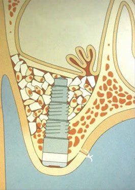 Implantat mit Fllmaterial stabilisiert