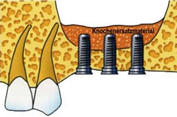 Darstellung 3 eingesetzter Schraubimplantate